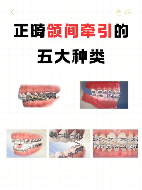 牙齿矫正粗细钢丝作用有何区别？-图3