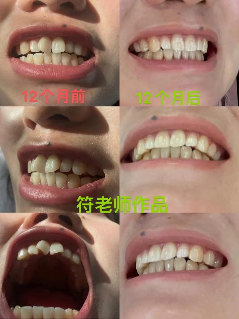 隐形矫正牙齿图片对比,效果真的能通过图片看出来吗?-图3 隐形矫正牙齿图片对比,效果真的能通过图片看出来吗?-图3