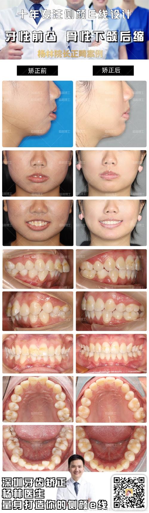 深圳牙齿矫正哪家最好？如何选到靠谱又专业的机构？-图2
