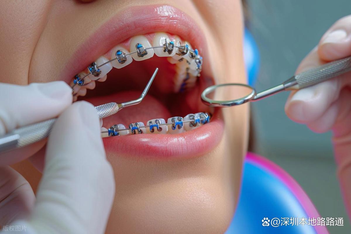 深圳牙齿矫正哪家最好？如何选到靠谱又专业的机构？-图3