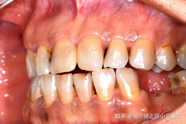 矫正牙齿导致牙龈萎缩-图3