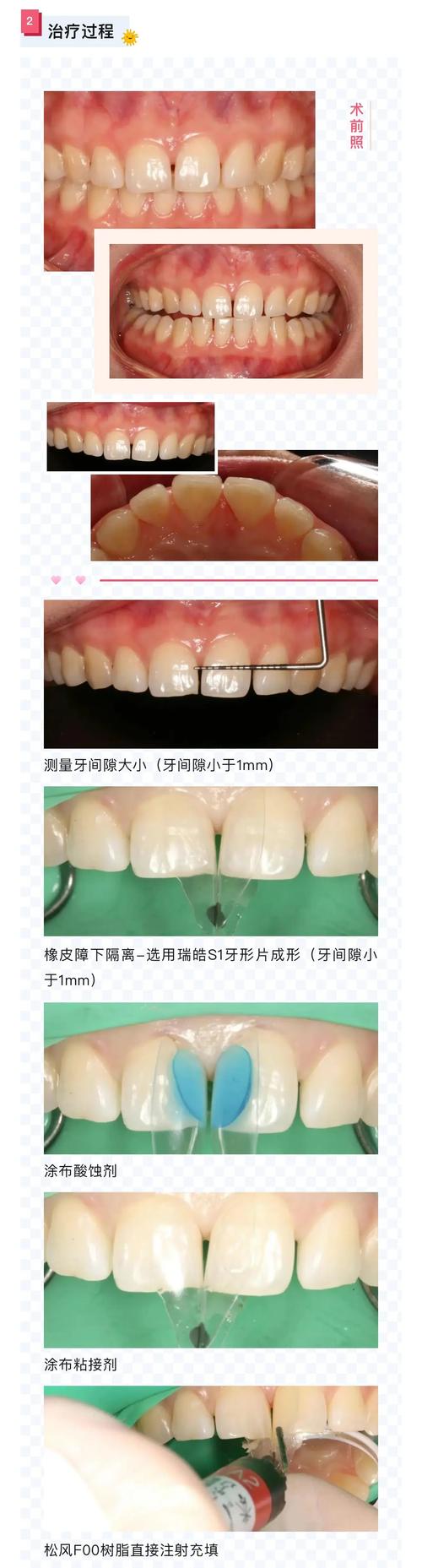 矫正牙齿关闭缝隙的过程是怎样的？具体步骤有哪些？-图2