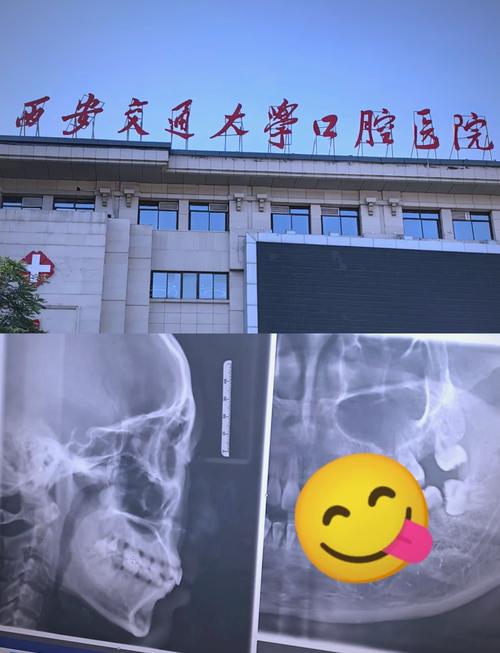 西安矫正牙齿哪里性价比高?-图2 西安矫正牙齿哪里性价比高?-图2