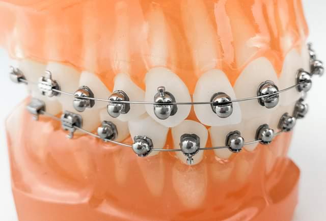 进口牙齿矫正托槽价格为何差异大？影响因素有哪些？-图1