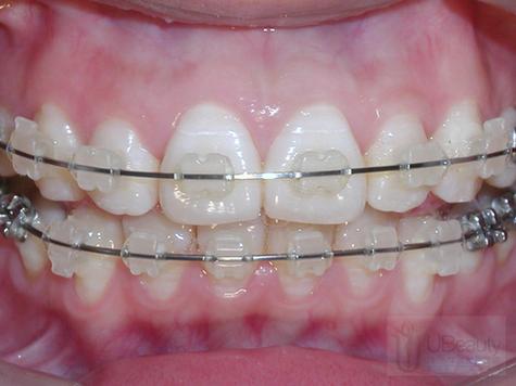 进口牙齿矫正托槽价格为何差异大？影响因素有哪些？-图2