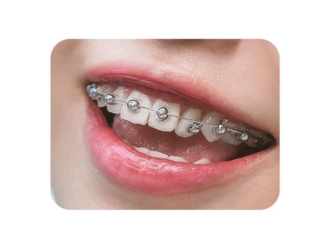 进口牙齿矫正托槽价格为何差异大？影响因素有哪些？-图3