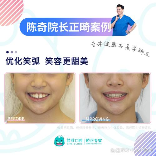 矫正牙齿能改善下巴形态吗?-图2 矫正牙齿能改善下巴形态吗?-图2