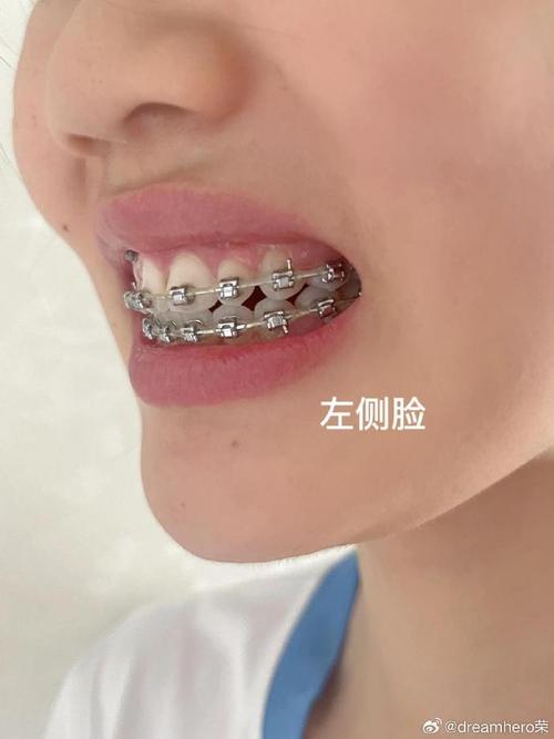 矫正后牙齿不咬合？原因探究与解决方法全解析-图2