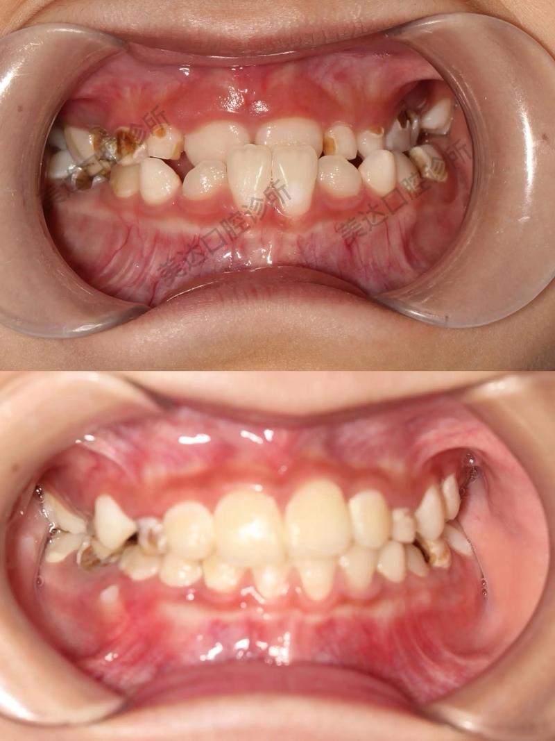 矫正完牙齿为什么会反弹？如何有效防止矫正效果反弹？-图1