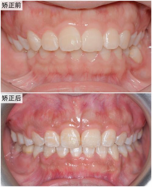 矫正牙齿一年后怀孕，对牙齿矫正效果和胎儿健康有影响吗？-图3