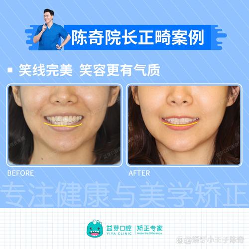 牙齿矫正对面部影响有多大？会改变脸型吗？-图3