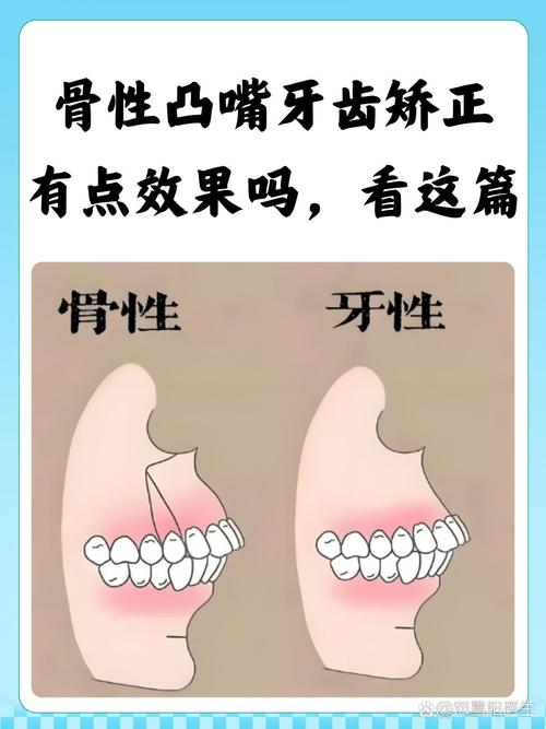 牙齿矫正对面部影响有多大？会改变脸型吗？-图2