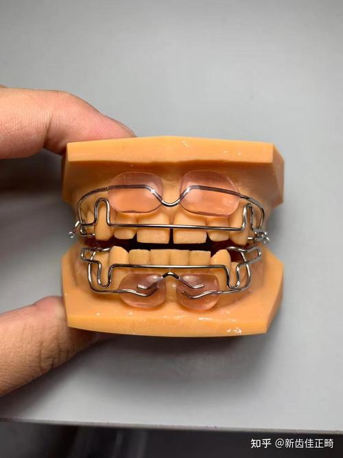 牙齿矫正器品牌有哪些？热门品牌大盘点！-图1