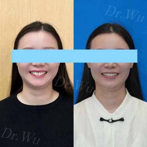 牙齿隐形矫正一般需要多长时间才能完成？-图3