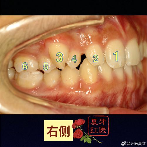 矫正后牙齿变形了，该如何有效解决？-图2