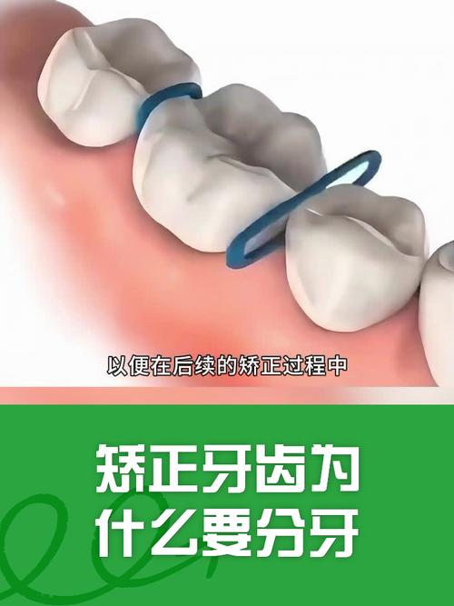 矫正牙齿的分牙是什么？分牙的作用、步骤及注意事项有哪些？-图3