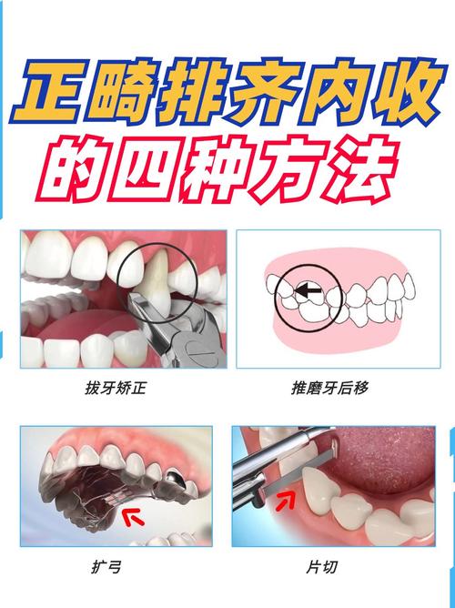 矫正牙齿会拔门牙吗？-图3