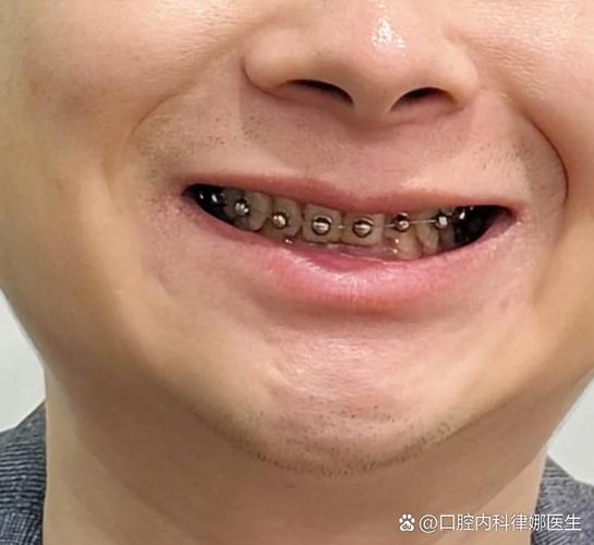 有坏牙可以矫正牙齿吗？-图3