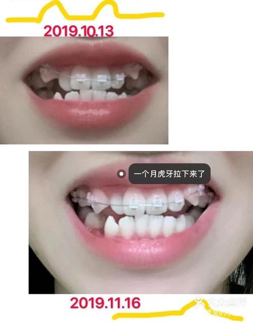 牙齿矫正后牙龈会红肿萎缩吗？这些变化正常吗？-图2