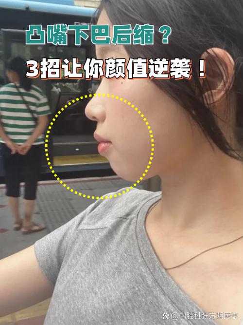 矫正牙齿对下巴的改变有多大?疑问解析-图3 矫正牙齿对下巴的改变有多大?疑问解析-图3