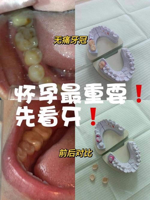 怀孕期间矫正牙齿可行吗?对胎儿有影响吗?-图1 怀孕期间矫正牙齿可行吗?对胎儿有影响吗?-图1