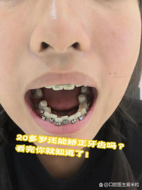 22岁能不能矫正牙齿?成年人矫正还来得及吗?-图2 22岁能不能矫正牙齿?成年人矫正还来得及吗?-图2