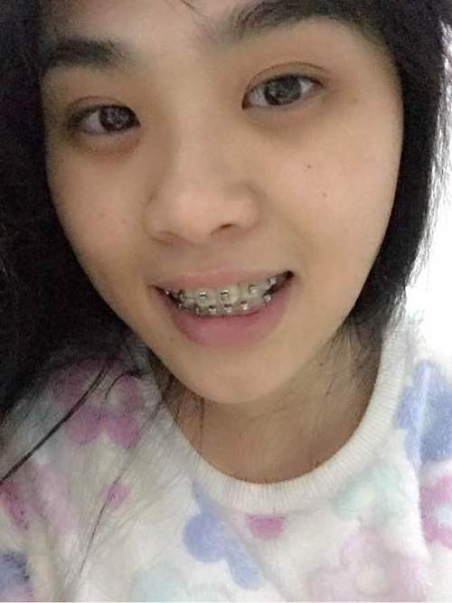 22岁能不能矫正牙齿?成年人矫正还来得及吗?-图3 22岁能不能矫正牙齿?成年人矫正还来得及吗?-图3