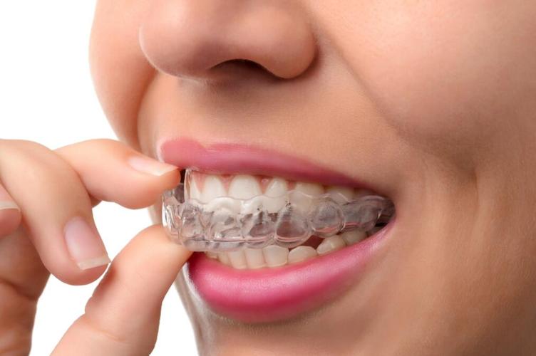 矫正牙齿能不戴牙套吗？有无替代矫正方式？-图3