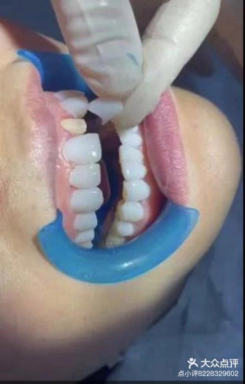 牙齿矫正美容冠是矫正牙齿还是美容修复？-图1