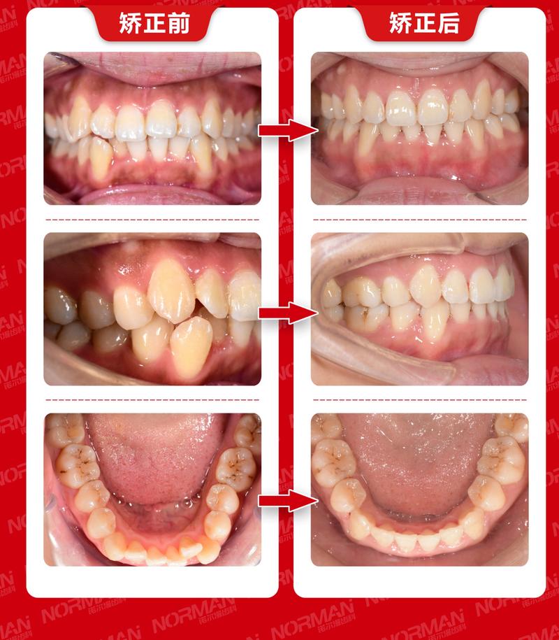 牙齿矫正前后对比图，效果真有那么惊艳吗？-图1