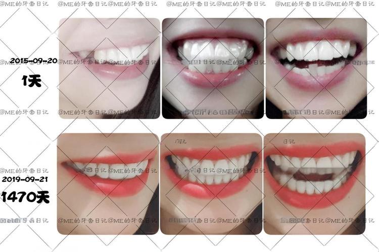 牙齿矫正前后对比图，效果真有那么惊艳吗？-图3
