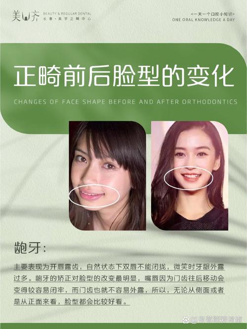 牙齿矫正改变脸型，图片效果真有这么神？-图1