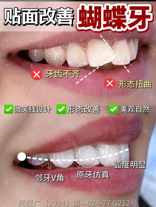 牙贴面能矫正牙齿吗？效果和局限有哪些？-图3