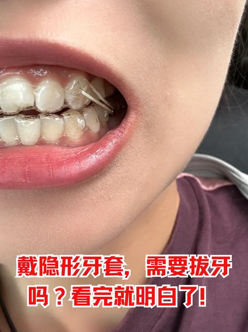隐形牙齿矫正，拔牙真的需要吗？-图1