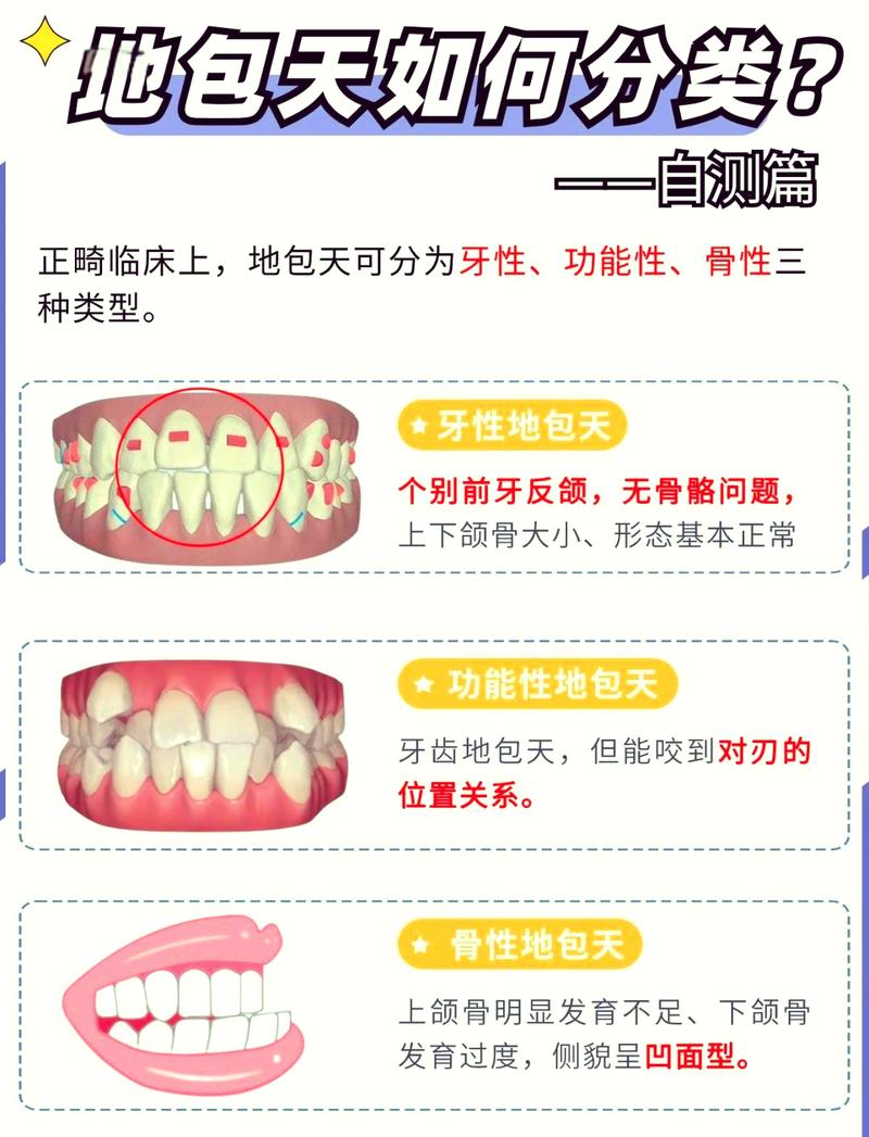 牙齿地包天矫正一般需要多长时间？-图1