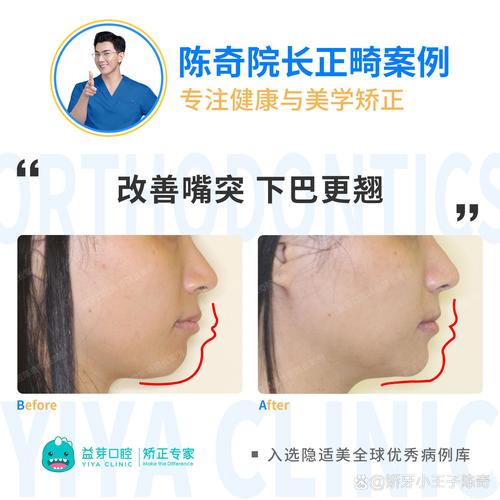 广州矫正牙齿去哪里好-图3