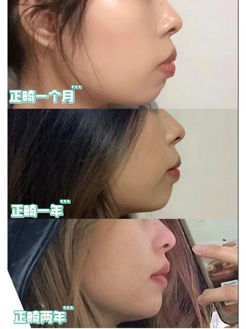 牙齿矫正嘴巴会变小吗-图1