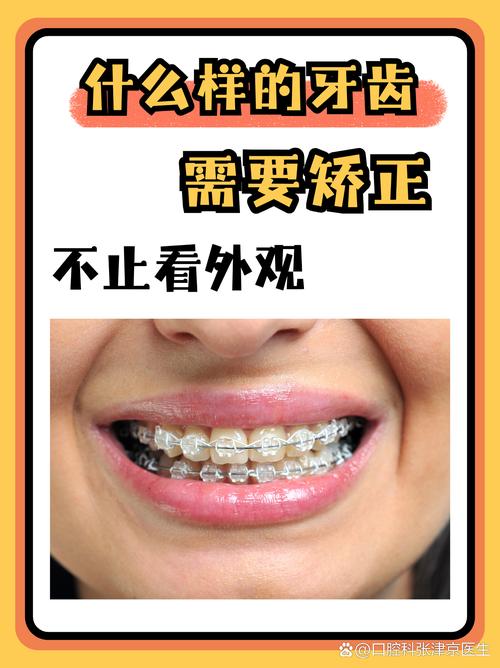 34岁矫正牙齿还来得及吗?-图2 34岁矫正牙齿还来得及吗?-图2