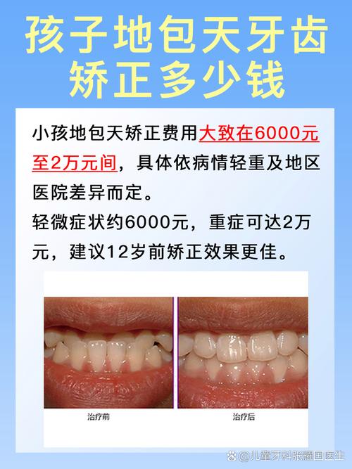 地包天矫正牙齿的价格范围是多少？-图2