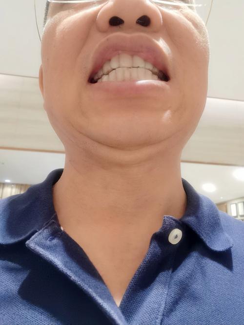 45岁矫正牙齿还来得及吗？晚不晚？-图2