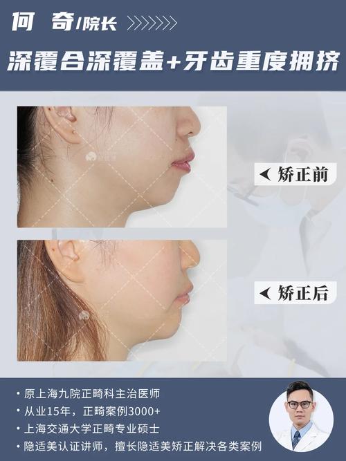 30岁还能矫正牙齿吗？-图2