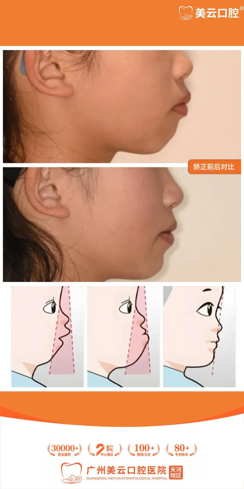 矫正牙齿真的能改变脸型吗?-图2 矫正牙齿真的能改变脸型吗?-图2