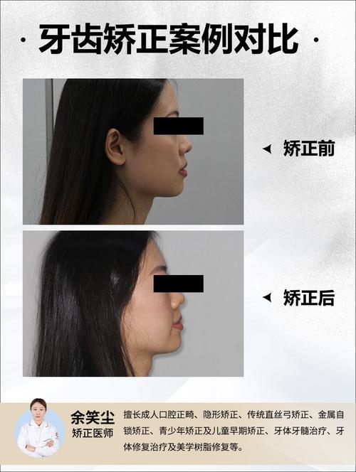 矫正牙齿真的能改变脸型吗?-图3 矫正牙齿真的能改变脸型吗?-图3