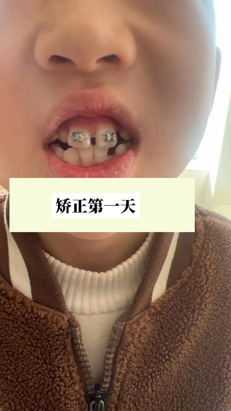 宁波牙齿矫正哪里最好-图2