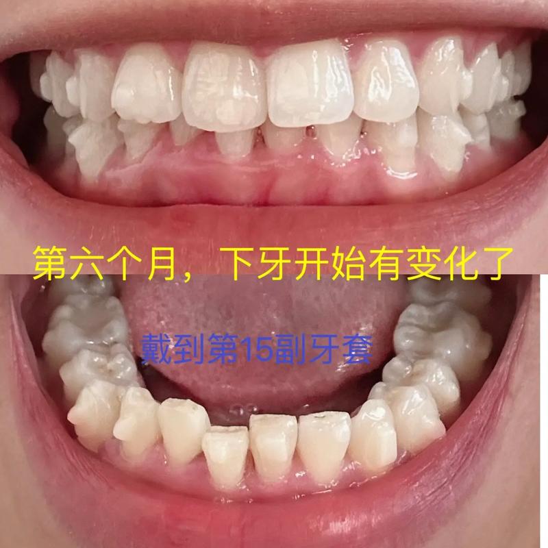 时代天使矫正牙齿效果-图2