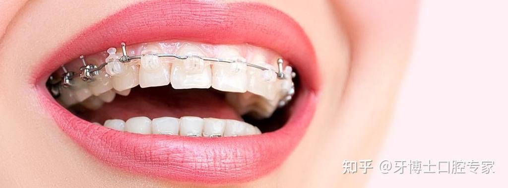 合肥牙齿矫正医院怎么选？哪家靠谱又效果好？求推荐！-图3