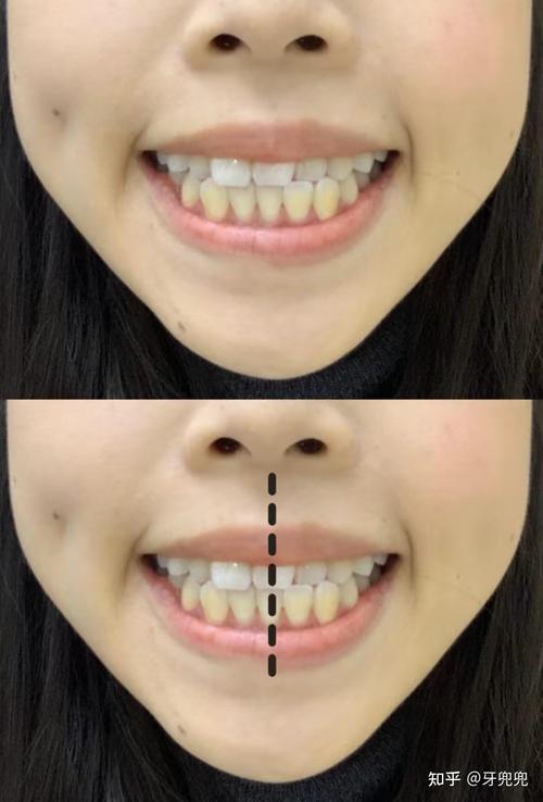 矫正牙齿后,牙齿真的会松动吗?-图1 矫正牙齿后,牙齿真的会松动吗?-图1