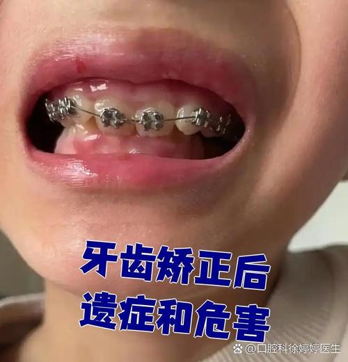 牙齿矫正后牙齿松动是正常现象吗？-图1