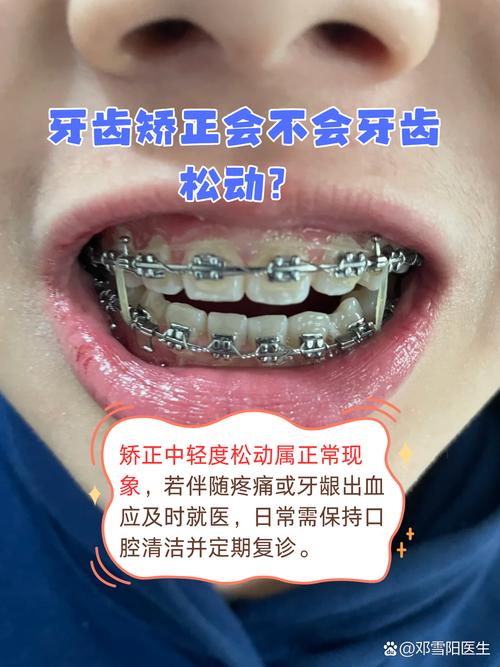 矫正期间牙齿松动怎么办?会影响最终矫正效果吗?-图1 矫正期间牙齿松动怎么办?会影响最终矫正效果吗?-图1