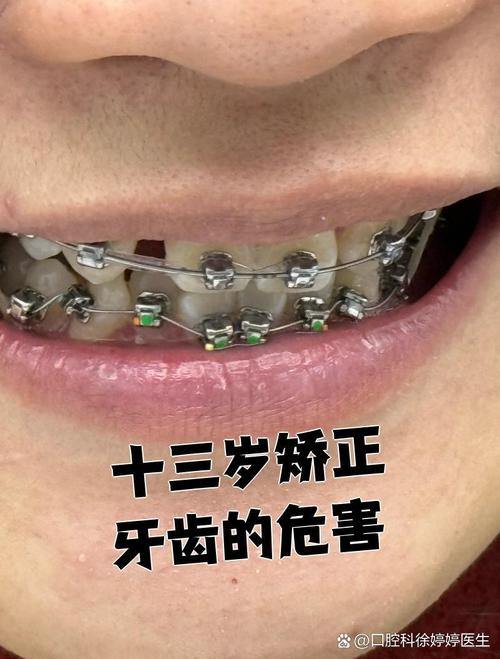 矫正期间牙齿松动怎么办?会影响最终矫正效果吗?-图2 矫正期间牙齿松动怎么办?会影响最终矫正效果吗?-图2